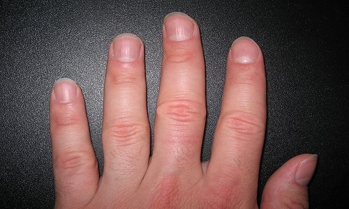 Why Do Fingernails Have Ridges?