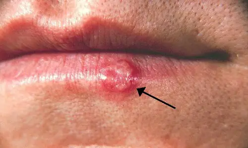 Why Do Fever Blisters Occur?