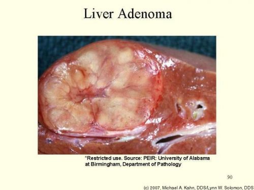 Difference between adenoma and carcinoma-1