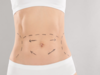 Before and After Tummy Tuck